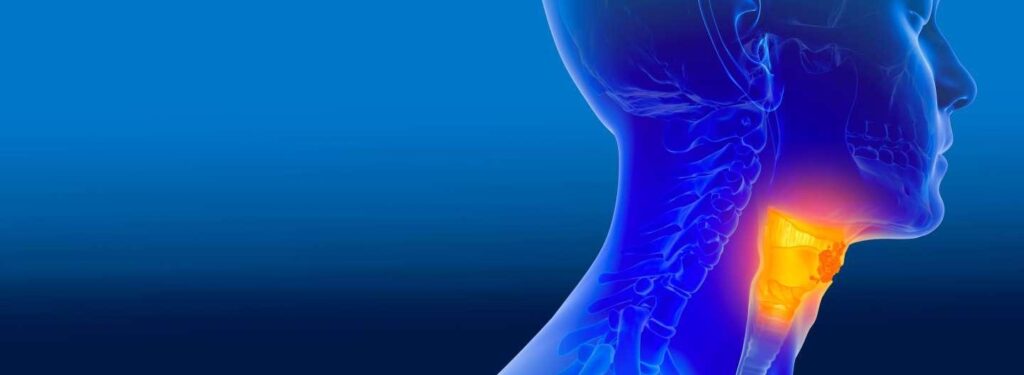 头颈癌是指一类发生在头颈部湿润表面鳞状细胞中的癌症。这些癌症可能出现在多个区域，包括口腔、咽喉、喉部、鼻腔和鼻窦。由于其相似的生物学行为和治疗方法，这些癌症常被归为一类。